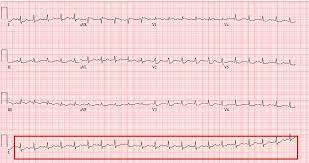 ECG (Electrocardiography)