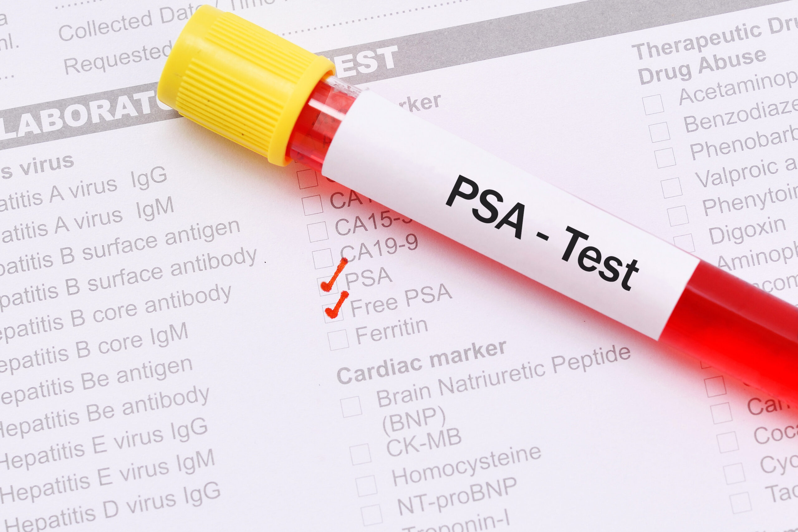 PSA (Prostrate Specific Antigen)