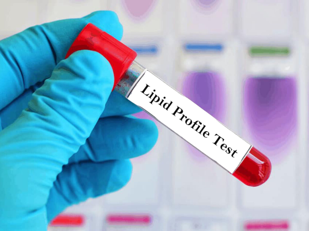 Lipid Profile