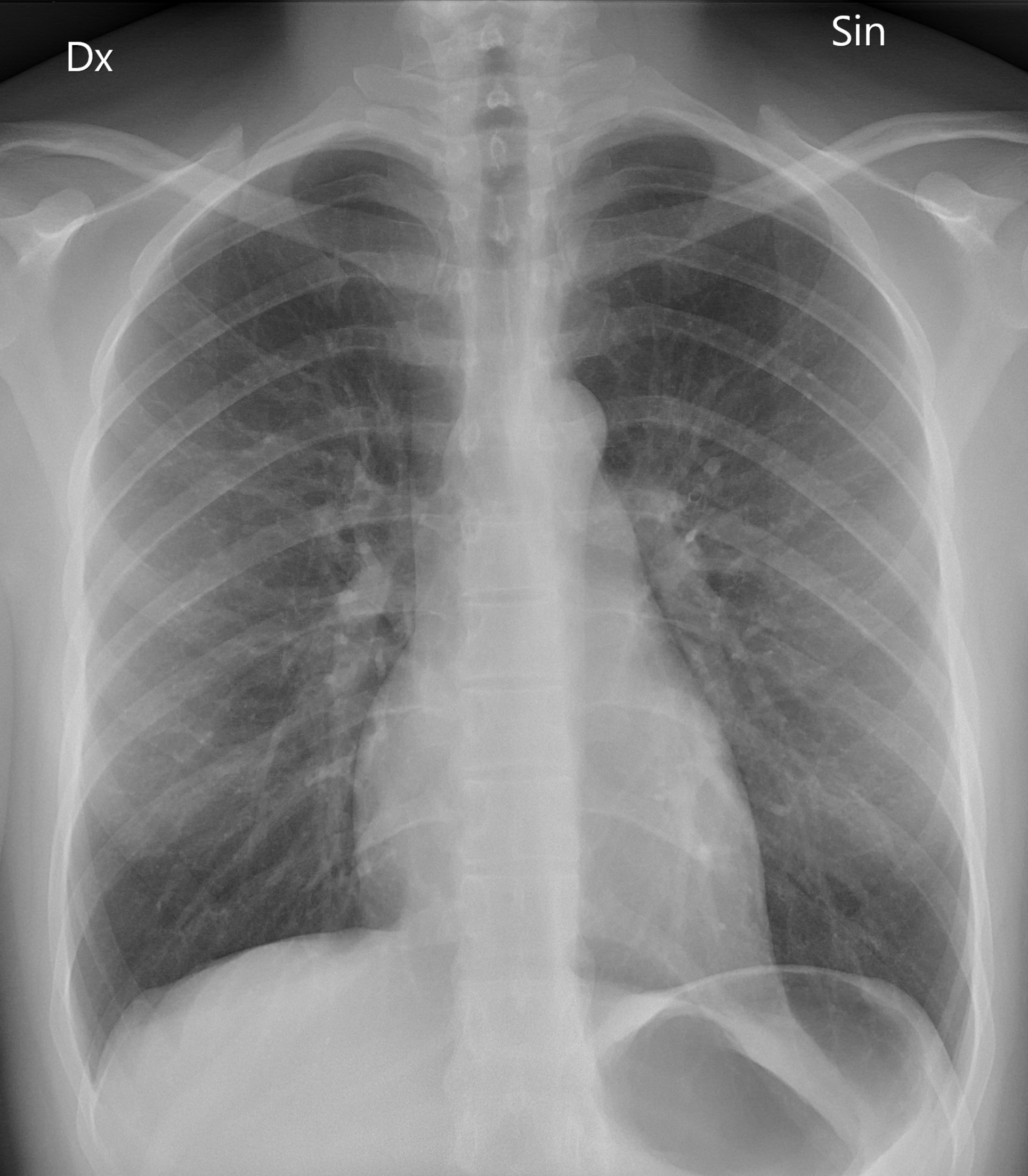 Chest X-Ray (Xray)